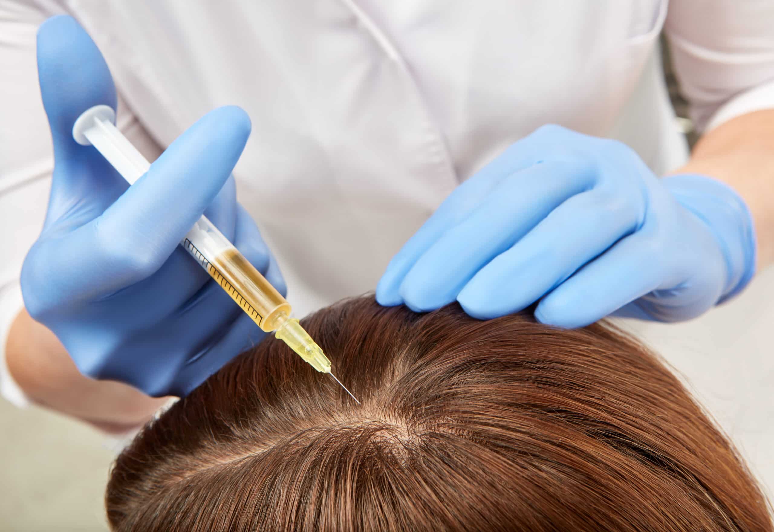 A medical provider administering prf hair loss treatment into the scalp via injection.