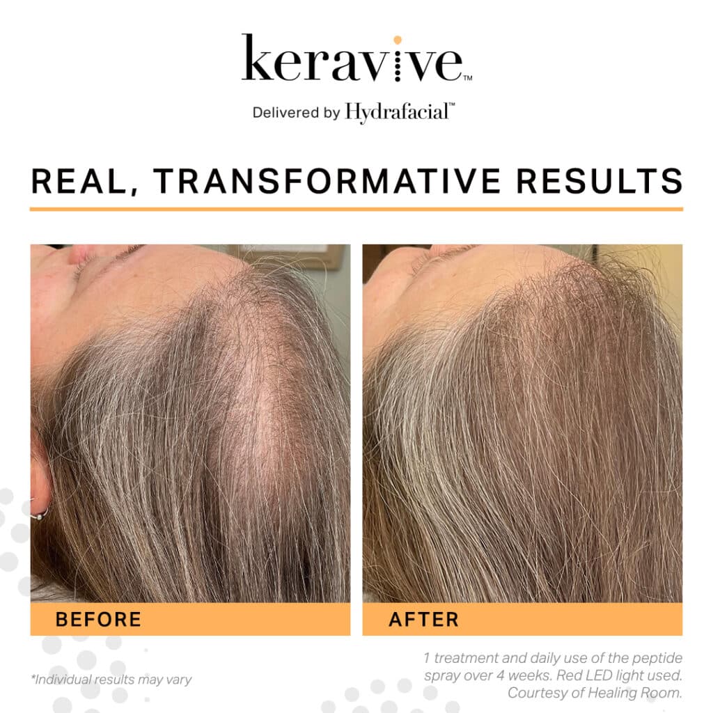Keravive by Hydrafacial is a scalp transforming therapy at Blue Medical Spa.