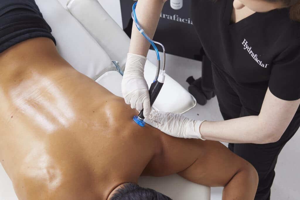 A man having a Hydrafacial performed on his back for acne clearance and pore decongestion.