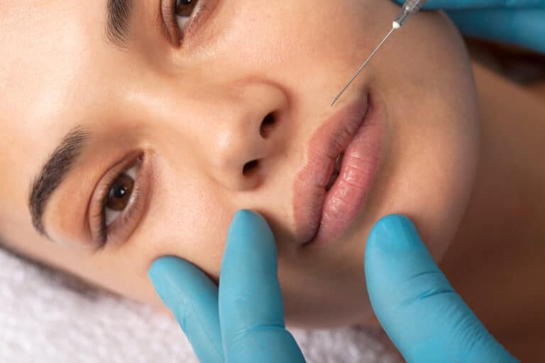 The Botox Lip Flip treatment at Blue Medical Spa.